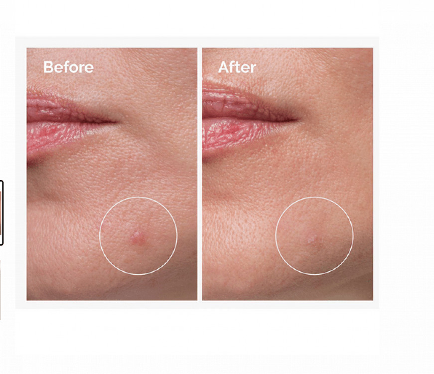 The Ordinary Sulfur 10% Powder to Cream Κρέμα Προσώπου κατά των Ατελειών & της Ακμής 5gr